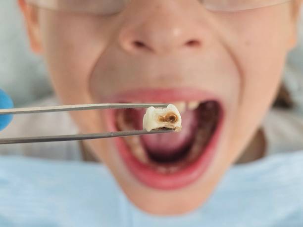Best Emergency Broken Tooth Repair in Berino, NM